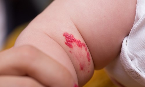 Hemangióm na koži – kozmetická vada či vážny zdravotný problém?