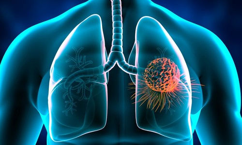 Čo zvyšuje riziko rakoviny pľúc? Je rizikovým faktorom len fajčenie?