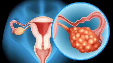 Hlavné rizikové faktory rakoviny vaječníkov: Je zásadná dedičnosť?