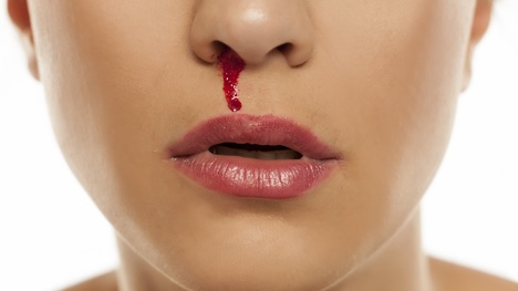 Krvácanie z nosa: Toto sú tipy a rady, ako ho zastaviť!