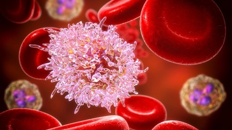 Chronická alebo akútna leukémia – aké prejavy poukazujú na rakovinu krvi?