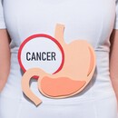 Rakovina žalúdka – aké sú príznaky, príčiny, spôsob diagnostiky a možnosti liečby?