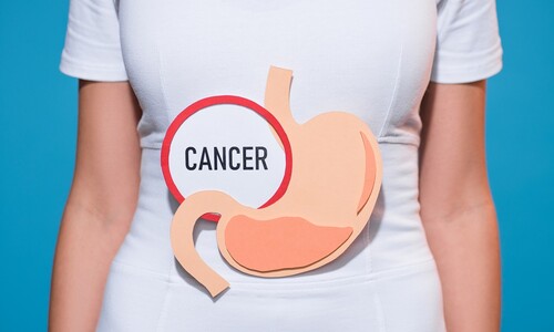 Rakovina žalúdka – aké sú príznaky, príčiny, spôsob diagnostiky a možnosti liečby?
