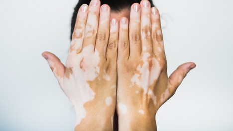 Vitiligo a jeho prejavy – sú biele fľaky na koži nákazlivé či bolestivé?